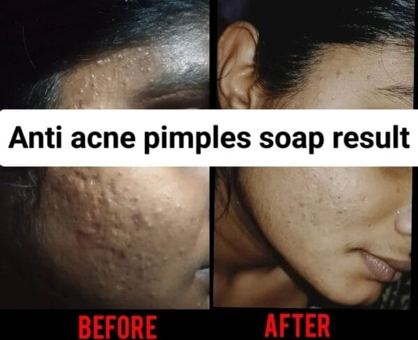 ANTI ACNE PIMPLES SOAP - Image 2